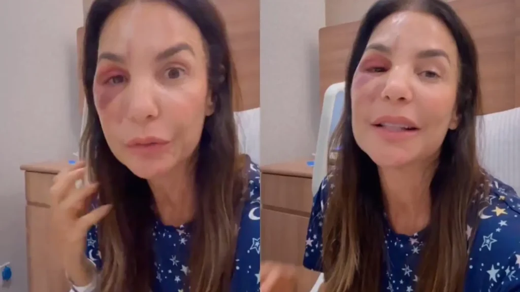 Ivete Sangalo faz cirurgia para corrigir fratura no maxilar após queda
